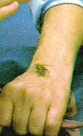 Abeja, picadura