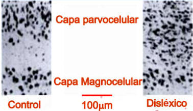 Coloración histológica del núcleo geniculado lateral mostrando la buena organización de las células parvocelulares y magnocelulares en una persona normal y su desorganización en una persona disléxica.